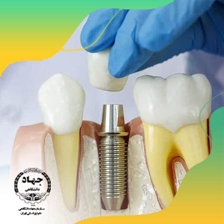 دوره جامع ایمپلنت دندانی (مقدماتی)